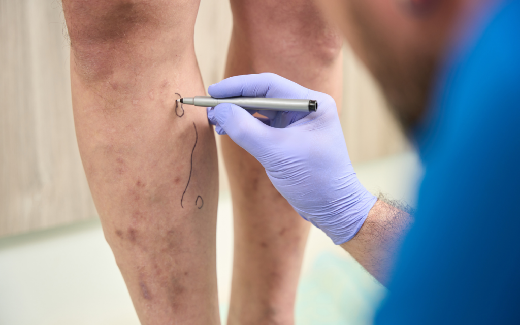 Varicose Vein