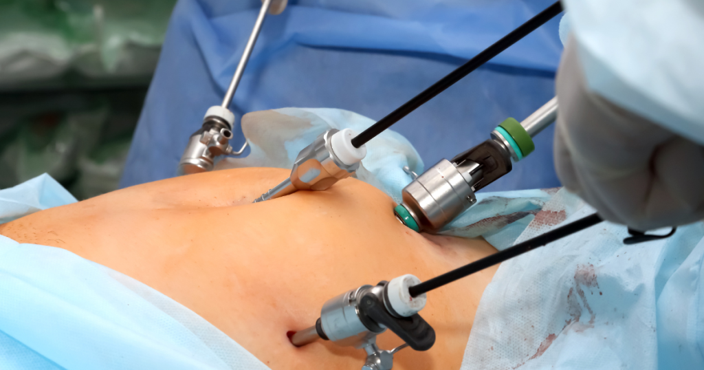 Laparoscopic Cholecystectomy: An Overview of the Procedure, Recovery Time, Cost & Risks